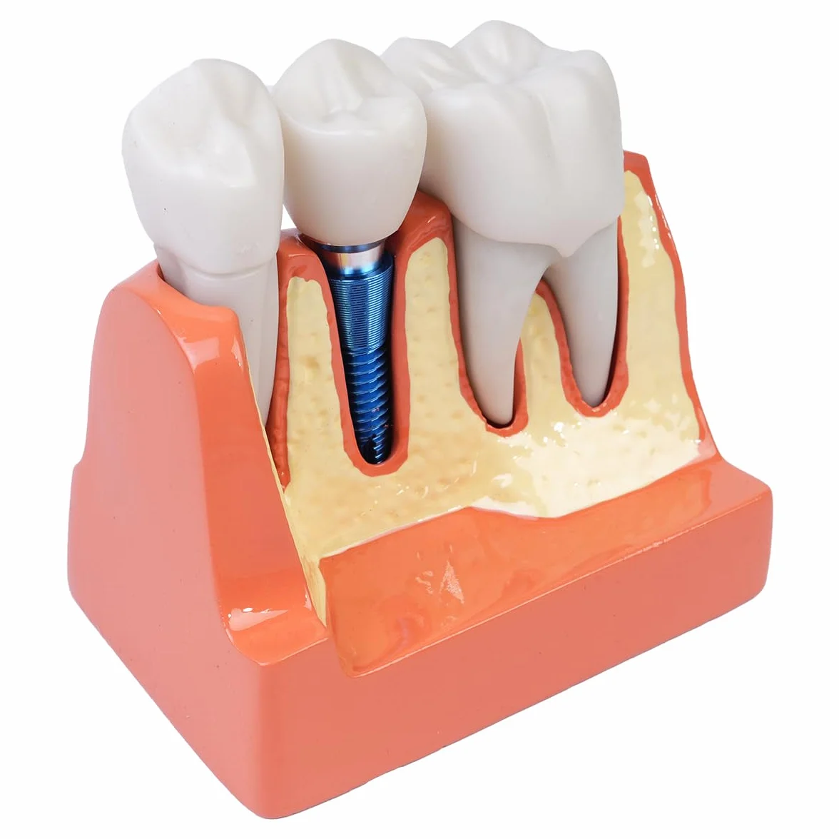 Sarini Modelo de Diente Oral, Modelo de implante Dental con Corona y Puente extraíbles para demostración y formación