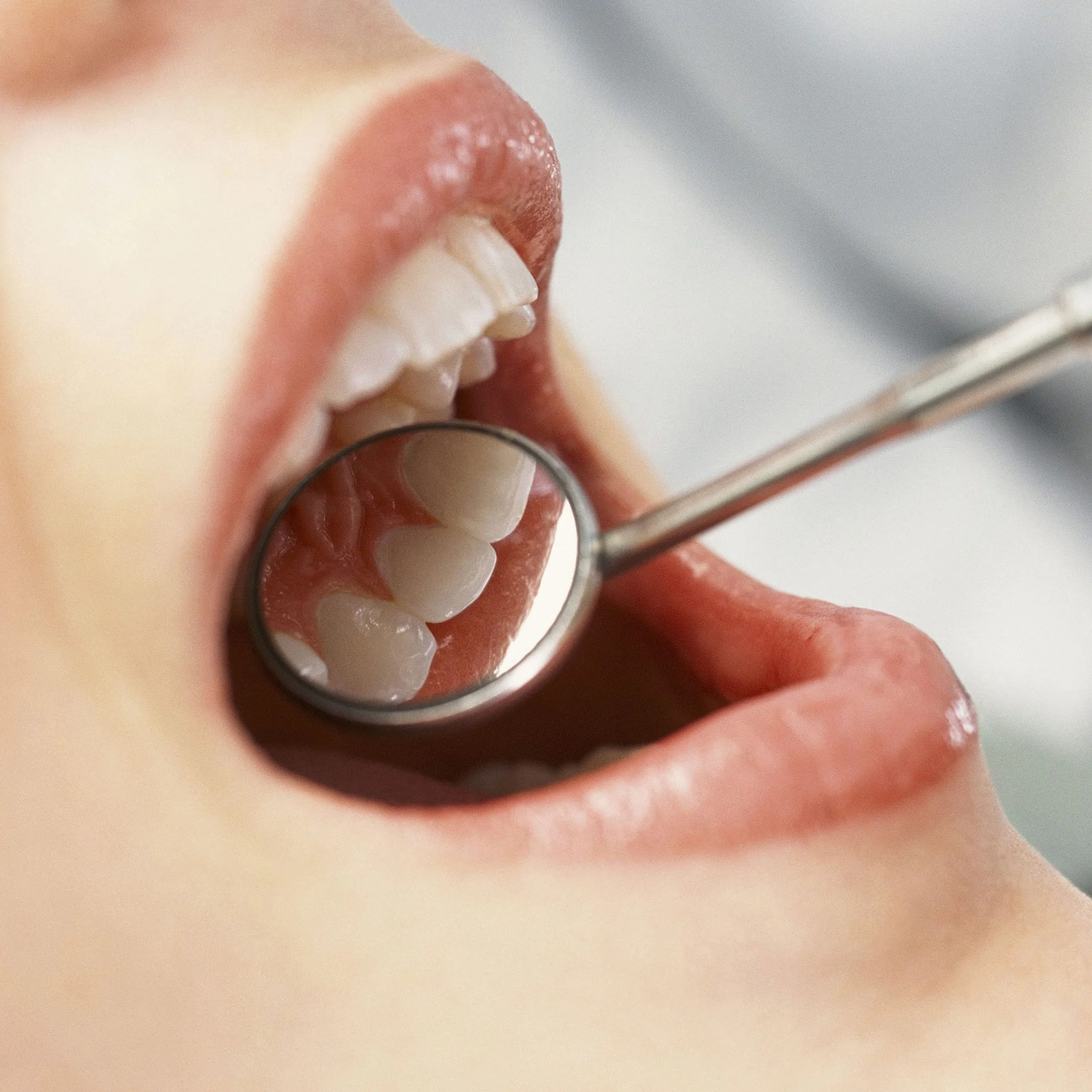 Specchietto Dentista Antiniebla Specchio Dentale Acero Inoxidable Higiene Dental