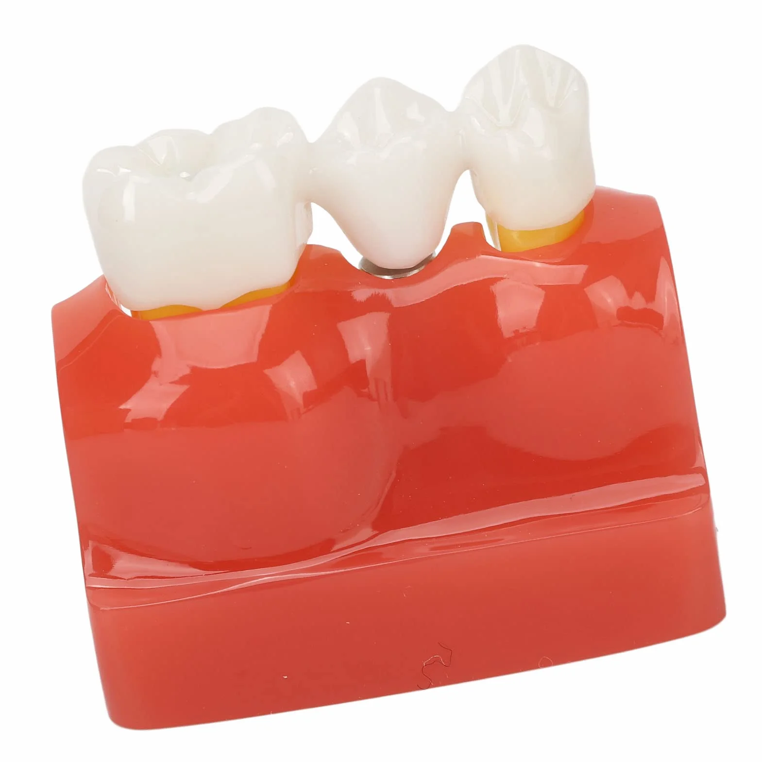 Modelo de implante Dental con Corona y Puente extraíbles para demostración y formación