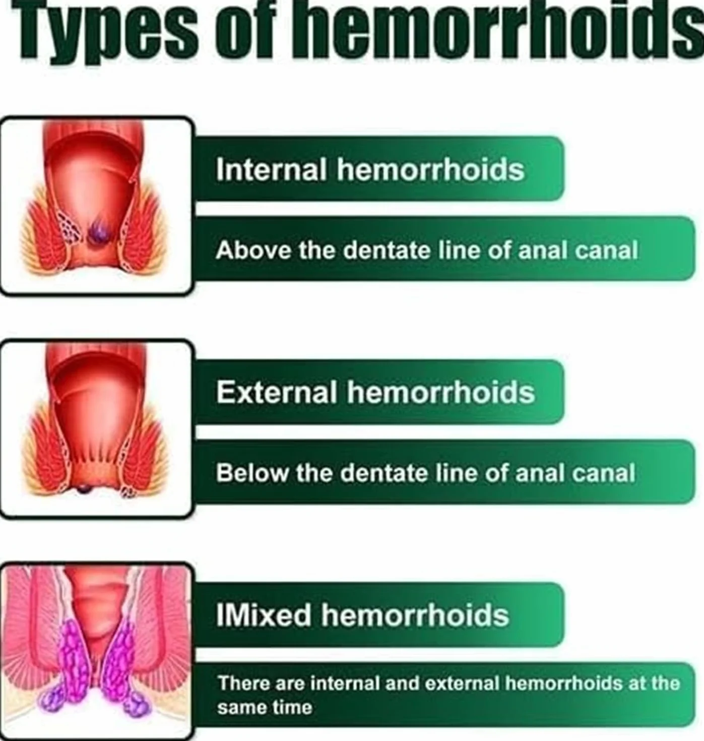 Crema Herbal para Hemorroides, Alivio Rápido de Picazón y Ardor Externos