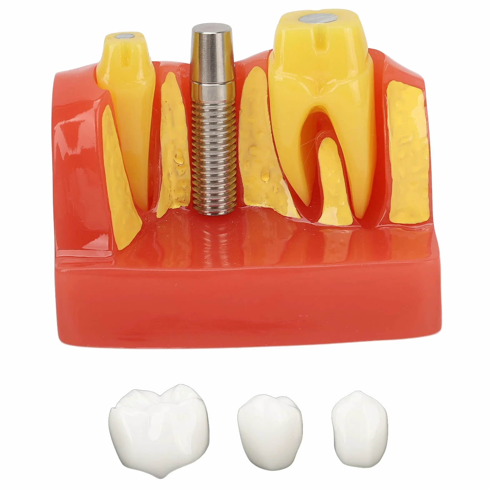 Modelo de implante Dental con Corona y Puente extraíbles para demostración y formación