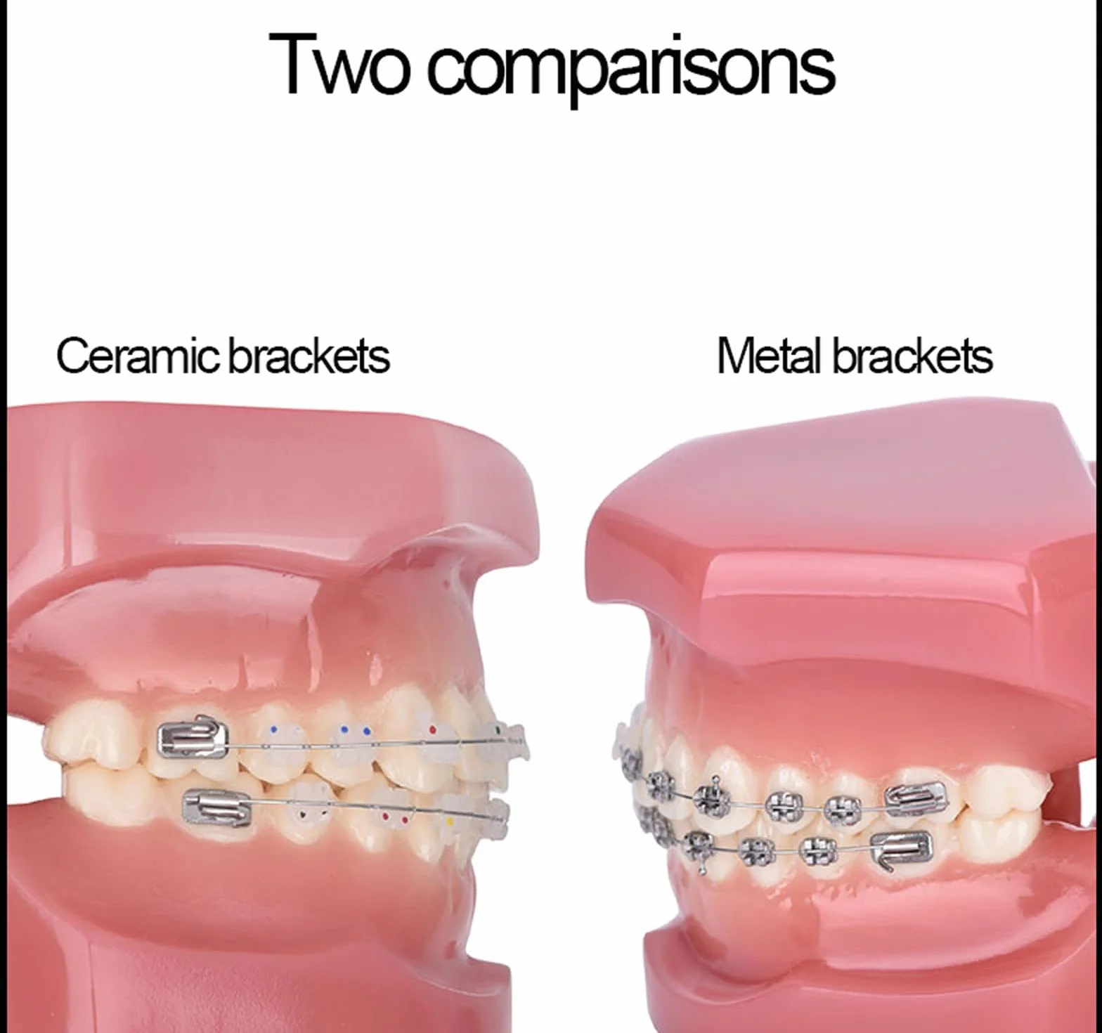 Modelo de Dientes Dentales de Ortodoncia con Brackets Cerámicos y Metálicos para Enseñanza Odontológica