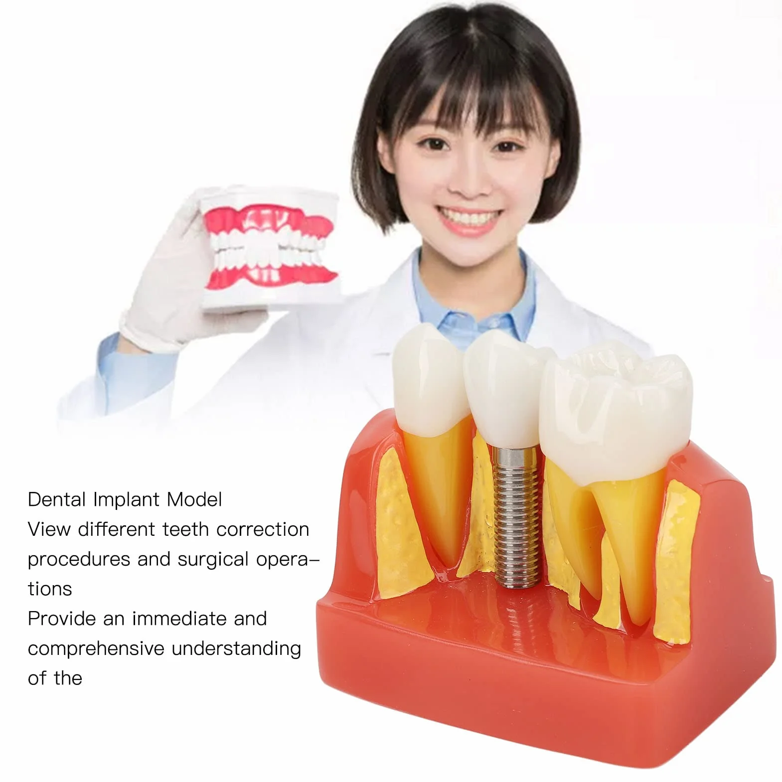 Modelo de implante Dental con Corona y Puente extraíbles para demostración y formación