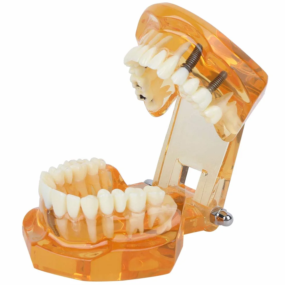 Modelo de Dientes para Demostración de Enfermedades Dentales Extraíble, Educativo Anatómico Profesional para Enseñanza Dental