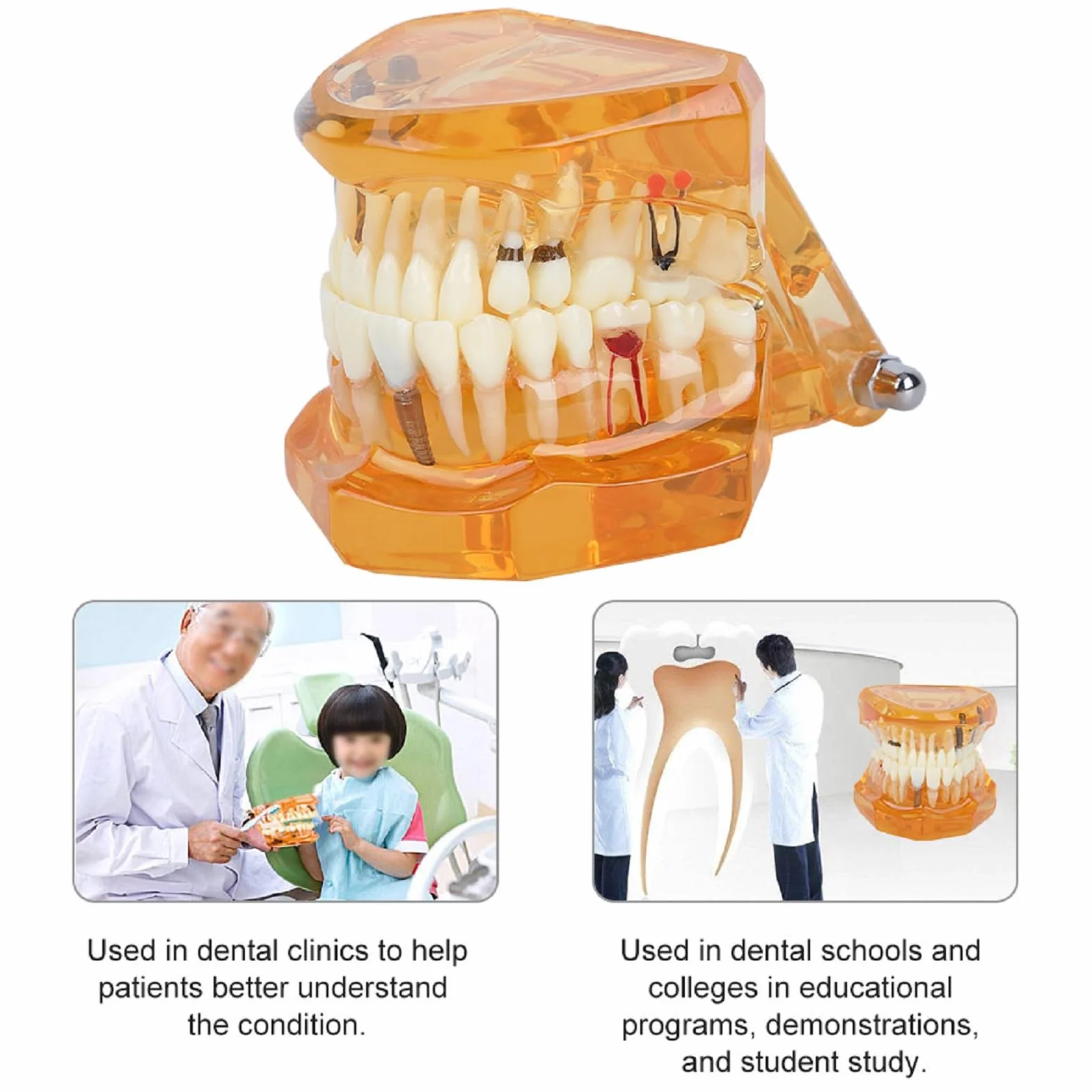 Modelo de Estudio de Dientes Dentales Extraíbles para Enseñanza Demostración Sobredentadura Maxilar Clínica Laboratorio Dentista