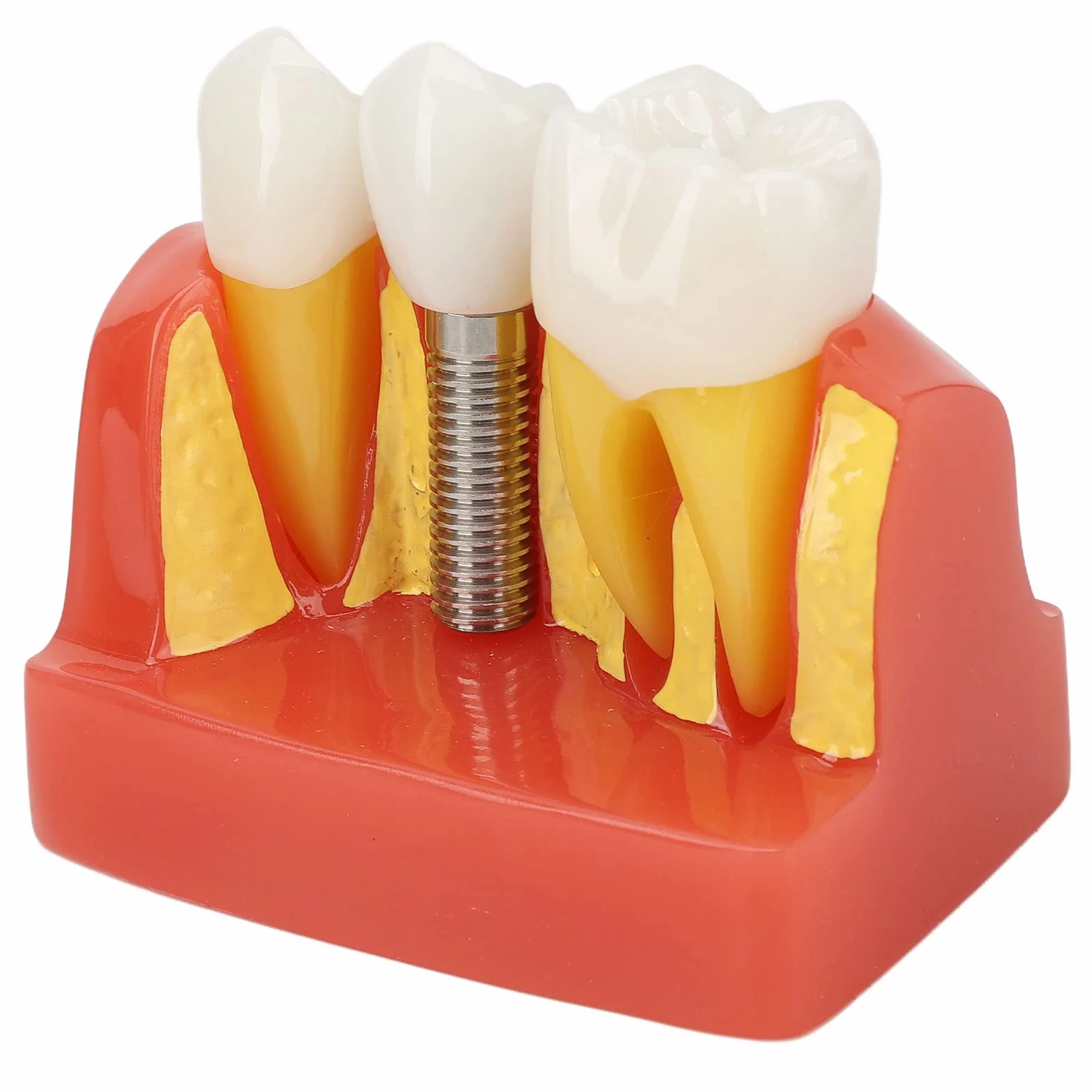 Modelo de implante Dental con Corona y Puente extraíbles para demostración y formación