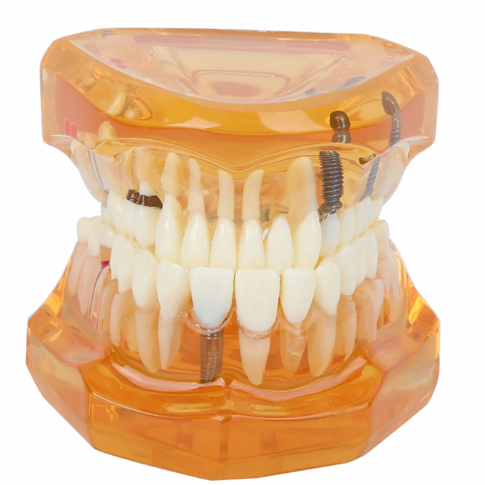 Modelo de Estudio de Dientes Dentales Extraíbles para Enseñanza Demostración Sobredentadura Maxilar Clínica Laboratorio Dentista