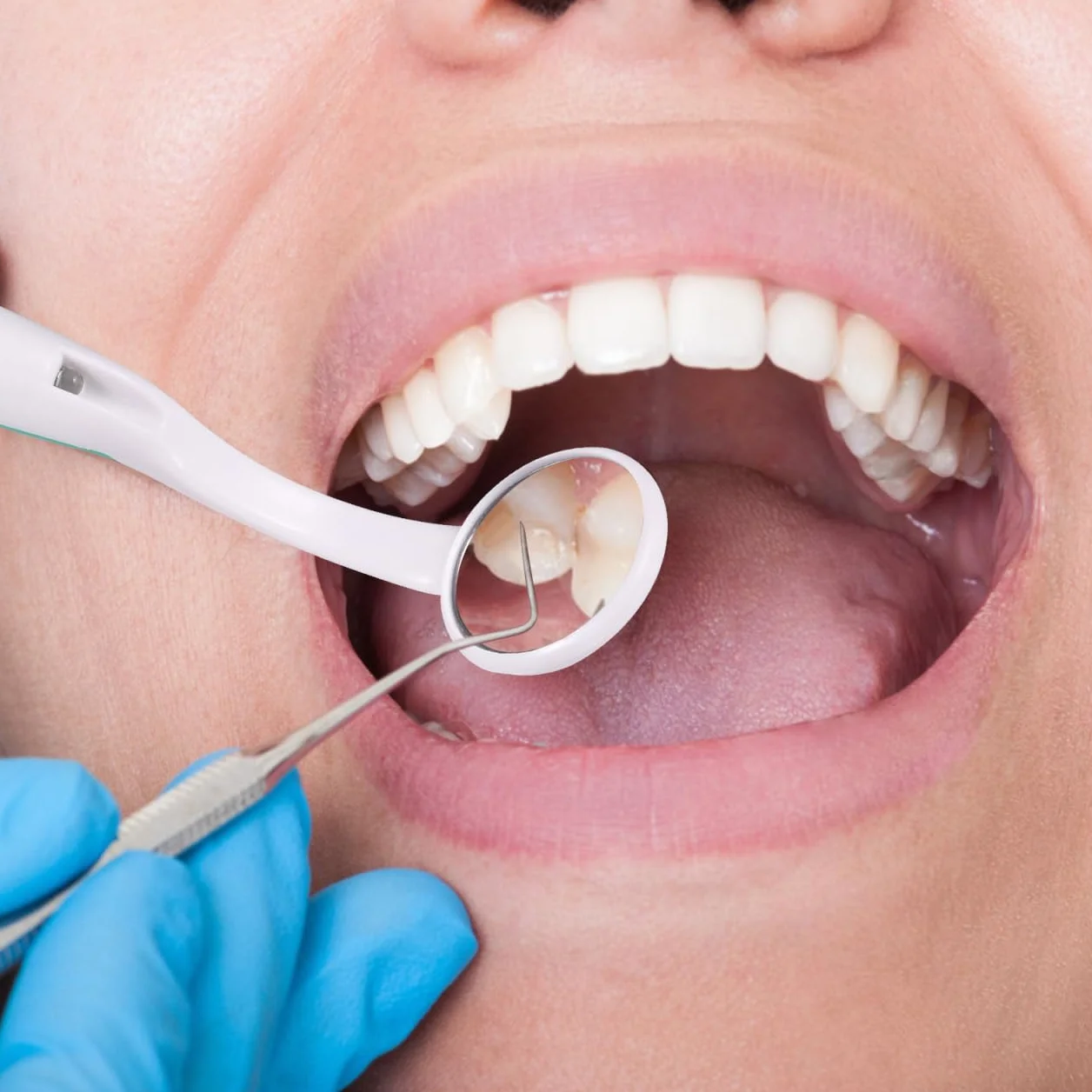 FOMIYES Espejo Dental con Luz LED Anti-Niebla para Inspección Oral (Verde)