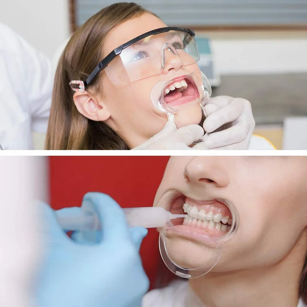 Vicloon Abridor de Boca Dental 12 PCS Retractores de Mejilla en forma de C Blanqueamiento de Dientes para Adultos