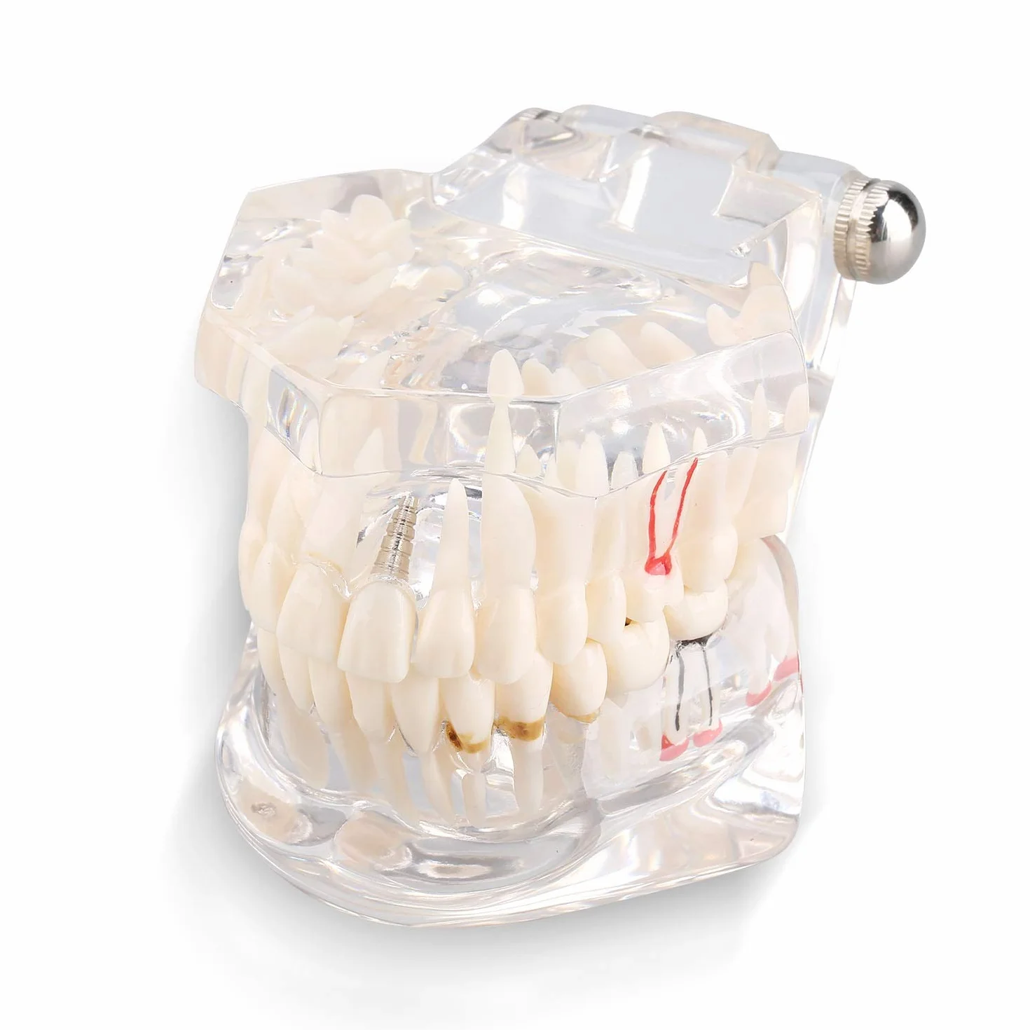 Modelo de Dientes Desmontable Adultos, Implantes Dentales, Enfermedad Transparente, Patología de Enseñanza