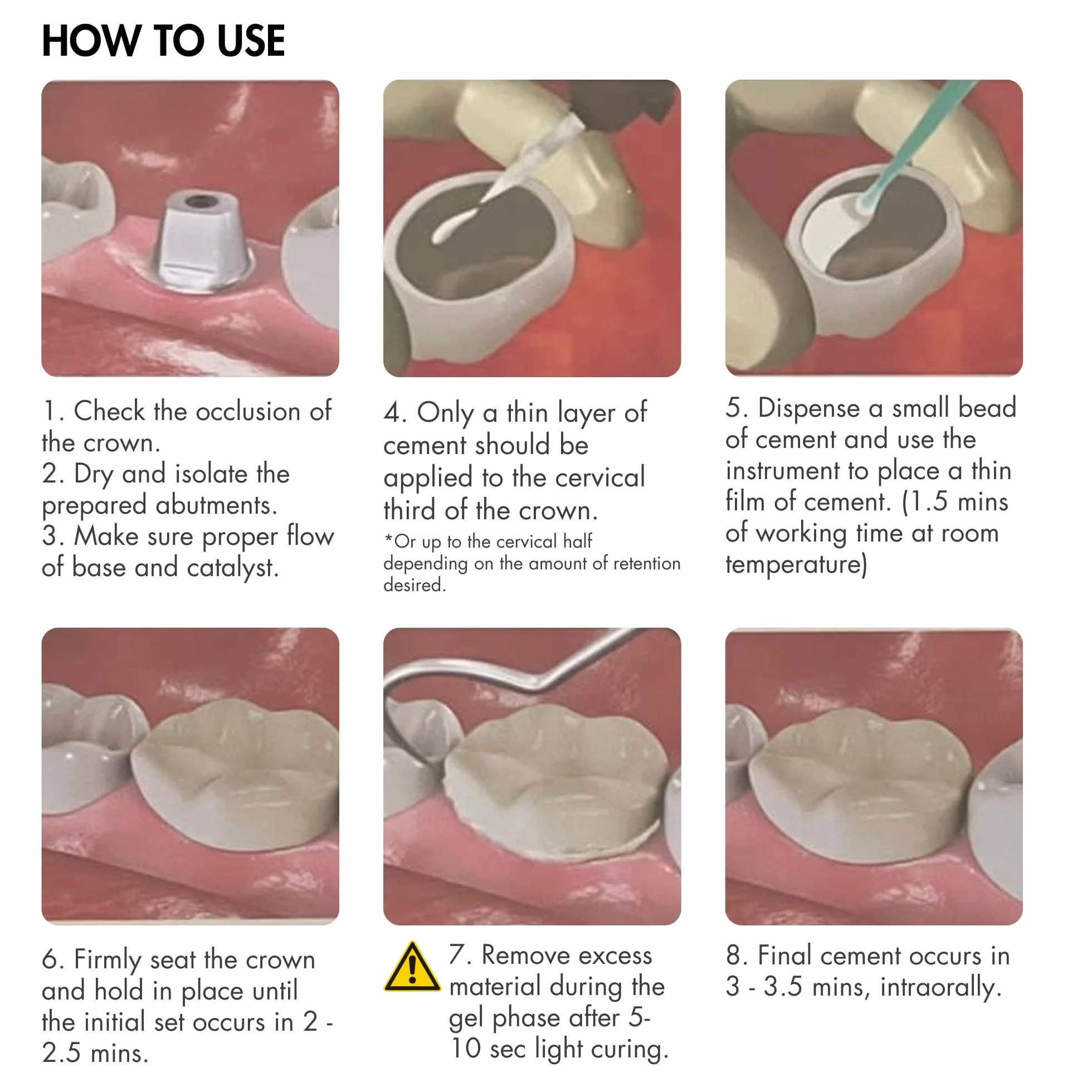 Cemento dental permanente autoadhesivo autoendurecible para coronas puentes postes Kit reparación dientes DIY 15 puntas EsCem