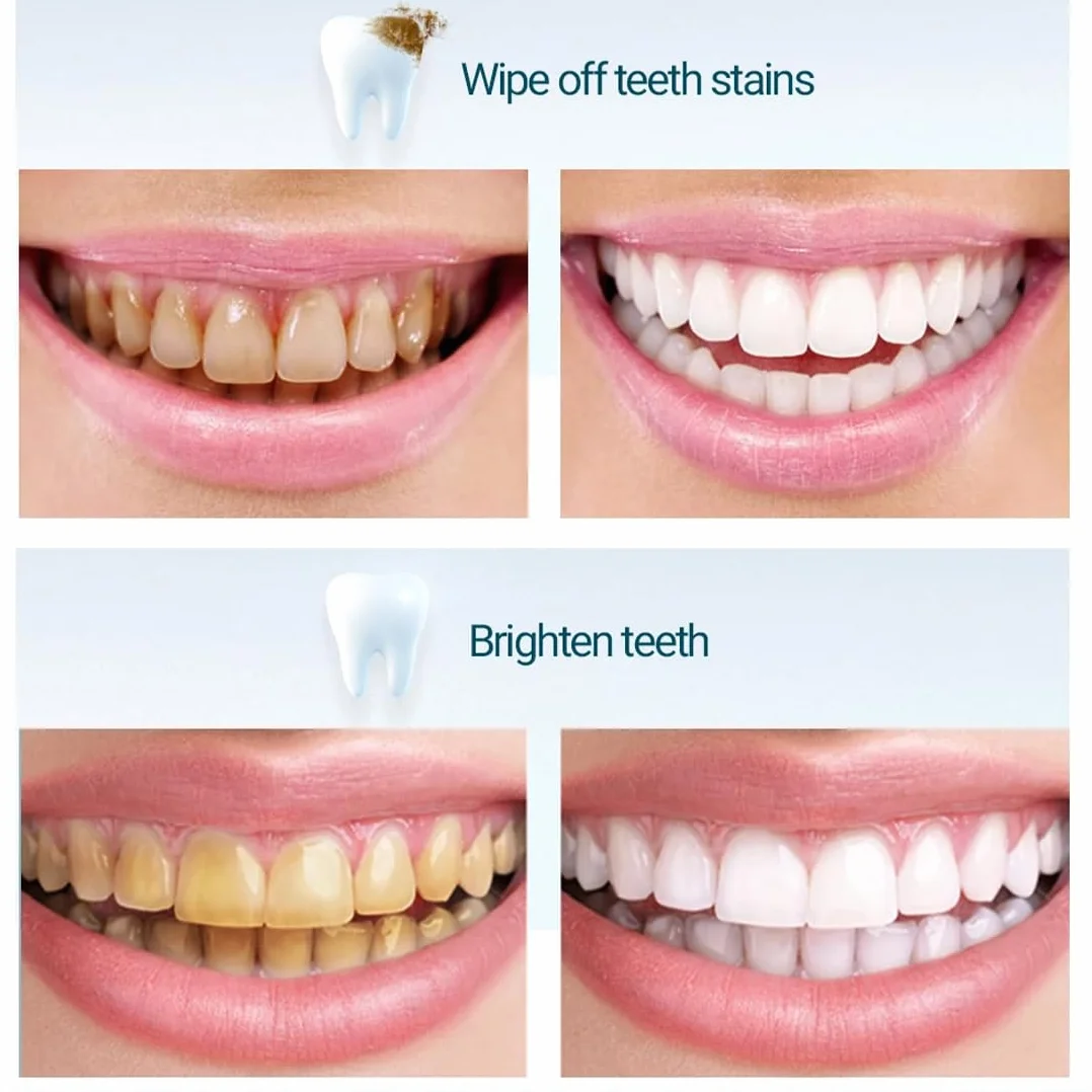 Tira De Pulido Dental Abrasivos Limpieza Profunda Dientes 4 Colores
