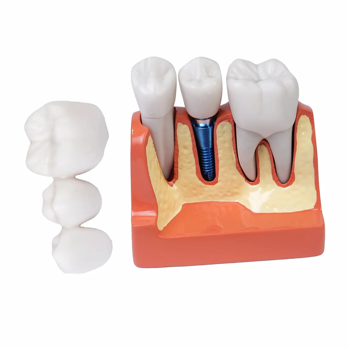Sarini Modelo de Diente Oral, Modelo de implante Dental con Corona y Puente extraíbles para demostración y formación