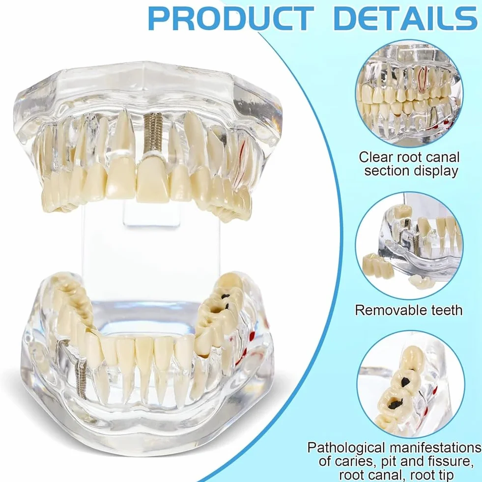 Typodonts Dental Modelo de Dientes para Implantes con Dientes Desmontables