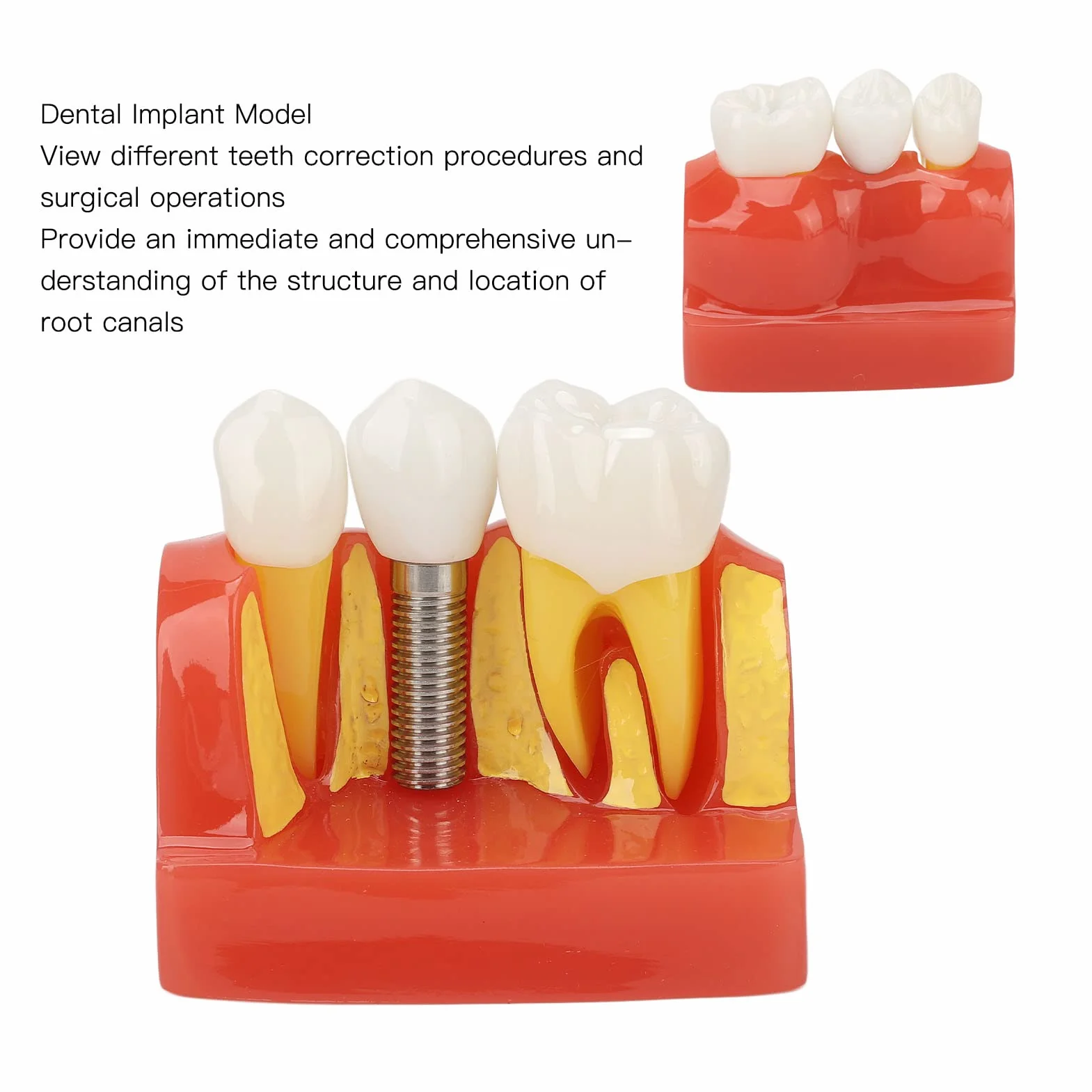 Modelo de implante Dental con Corona y Puente extraíbles para demostración y formación