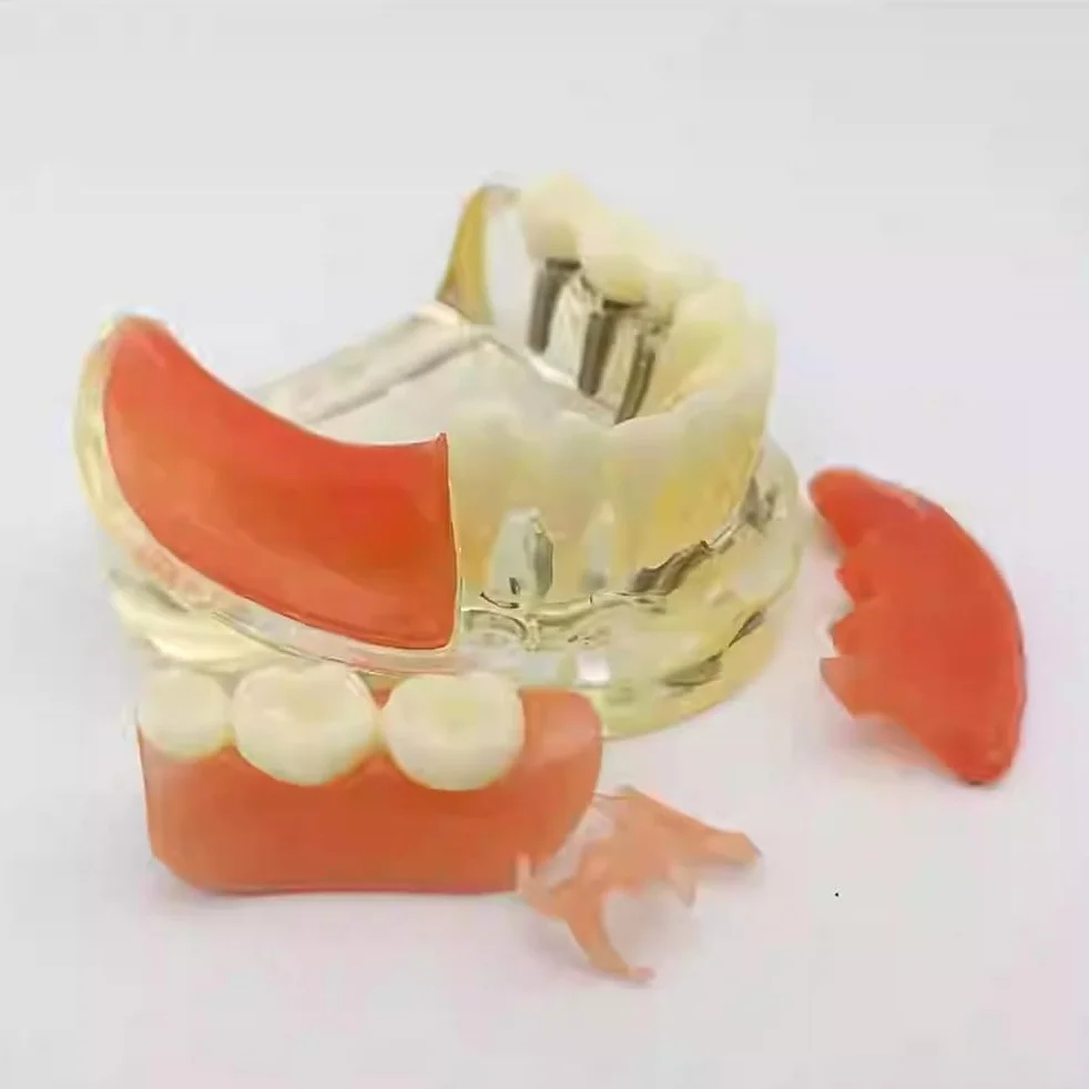 Implant-Supported Restorations Comparison Model Transparent Dental Implant Model Education Study