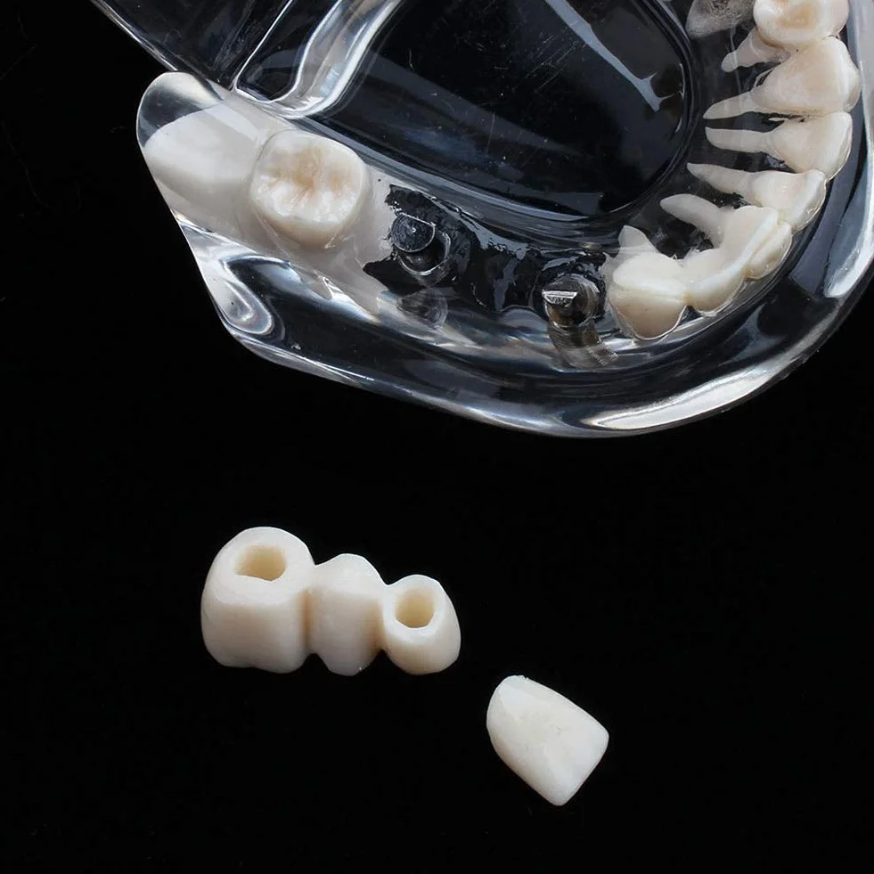 Modelo de Dientes Desmontable Adultos, Implantes Dentales, Enfermedad Transparente, Patología de Enseñanza