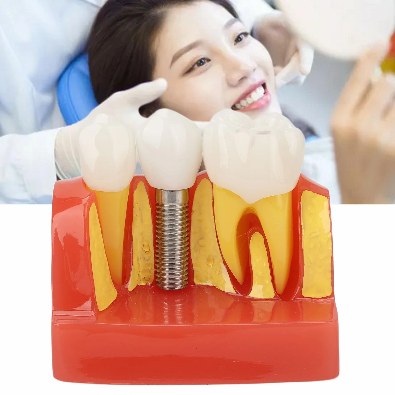 Modelo de implante Dental con Corona y Puente extraíbles para demostración y formación