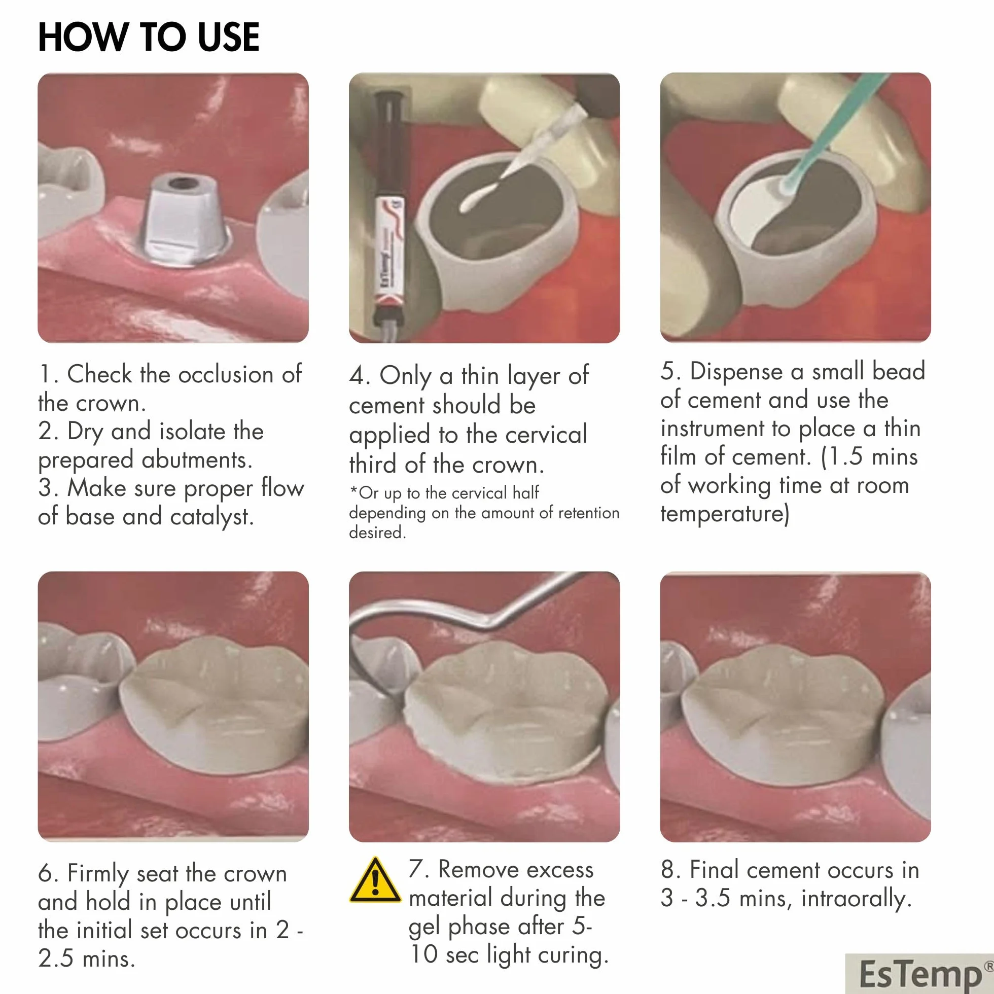 Cemento dental permanente ESTEMP para coronas puentes implantes