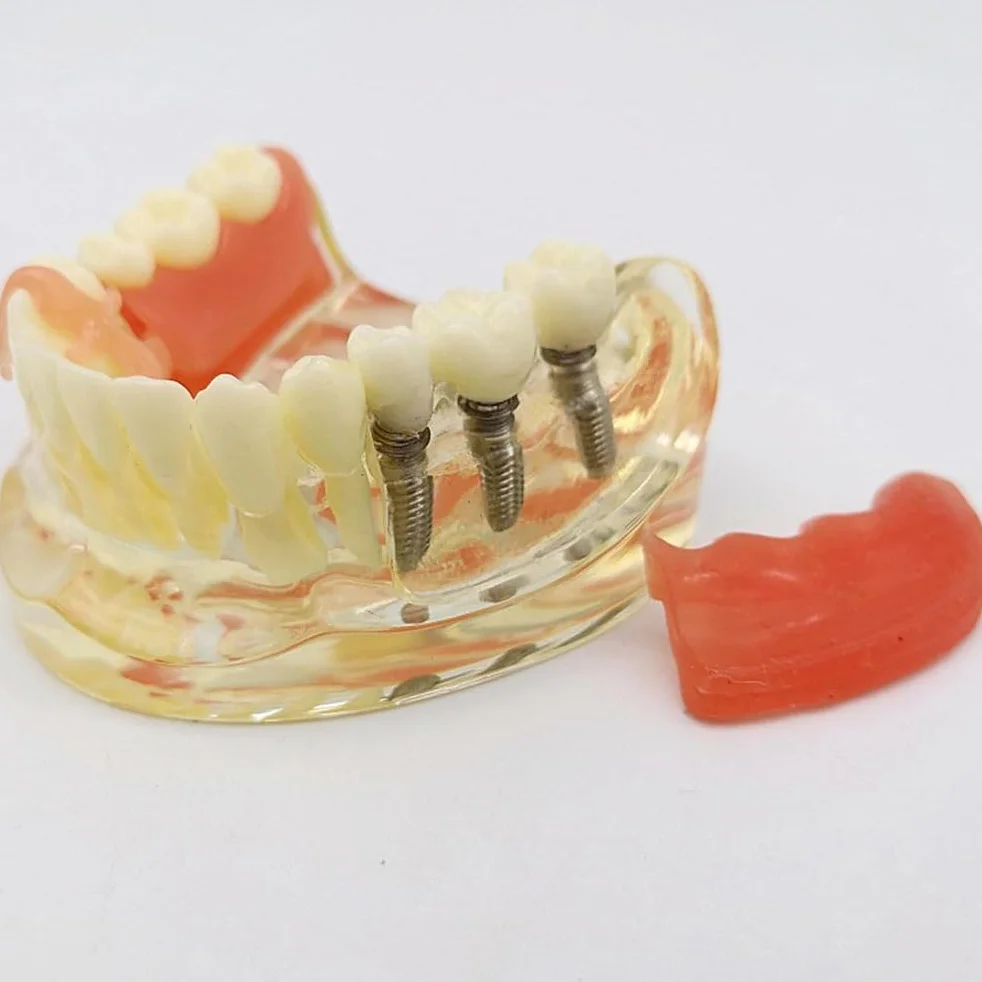 Implant-Supported Restorations Comparison Model Transparent Dental Implant Model Education Study