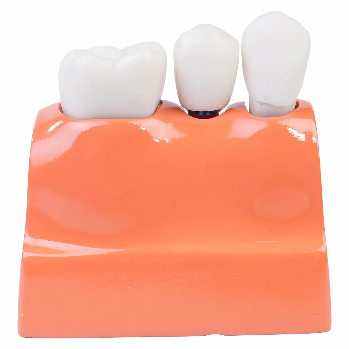 Sarini Modelo de Diente Oral, Modelo de implante Dental con Corona y Puente extraíbles para demostración y formación