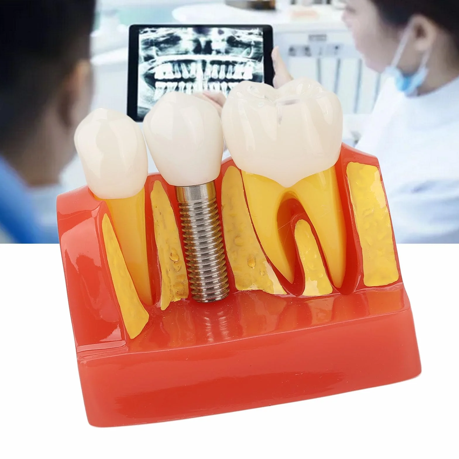 Modelo de implante Dental con Corona y Puente extraíbles para demostración y formación