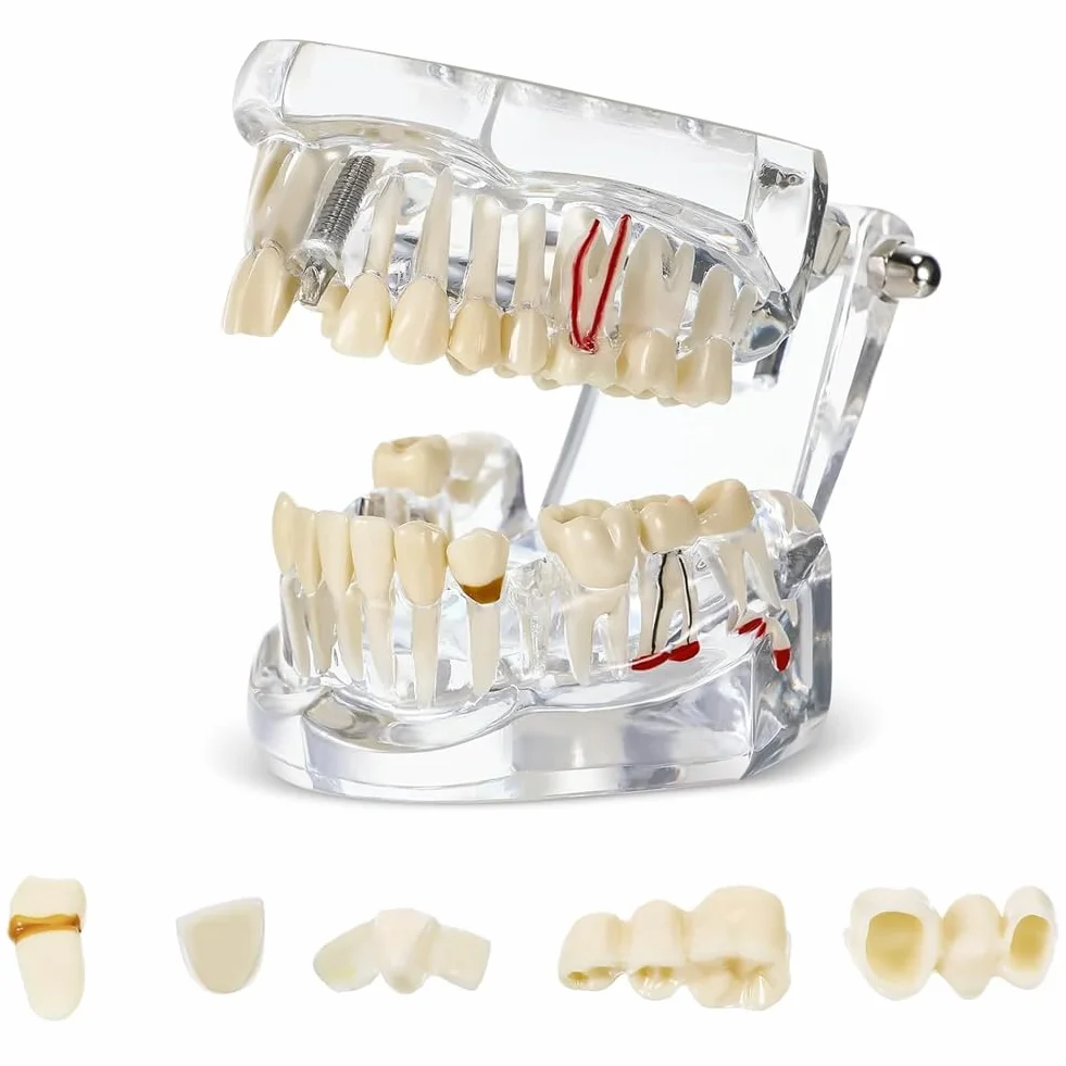 Typodonts Dental Modelo de Dientes para Implantes con Dientes Desmontables