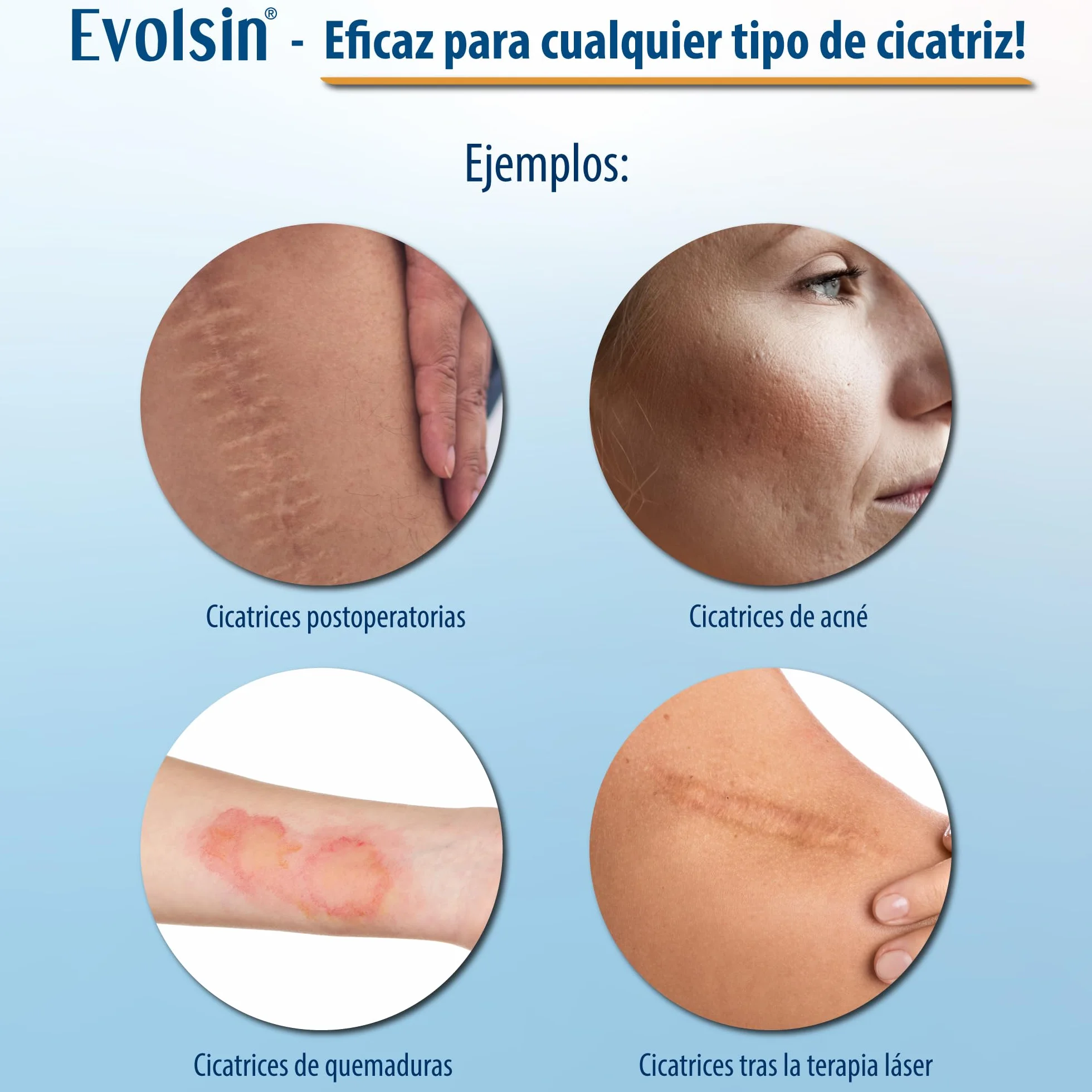 Evolsin parches cicatrizantes silicon scar sheets para cicatrices
