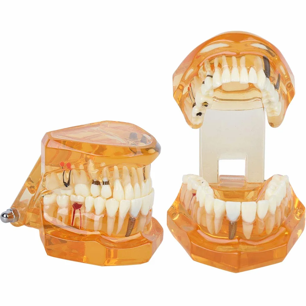 Modelo de Dientes para Demostración de Enfermedades Dentales Extraíble, Educativo Anatómico Profesional para Enseñanza Dental