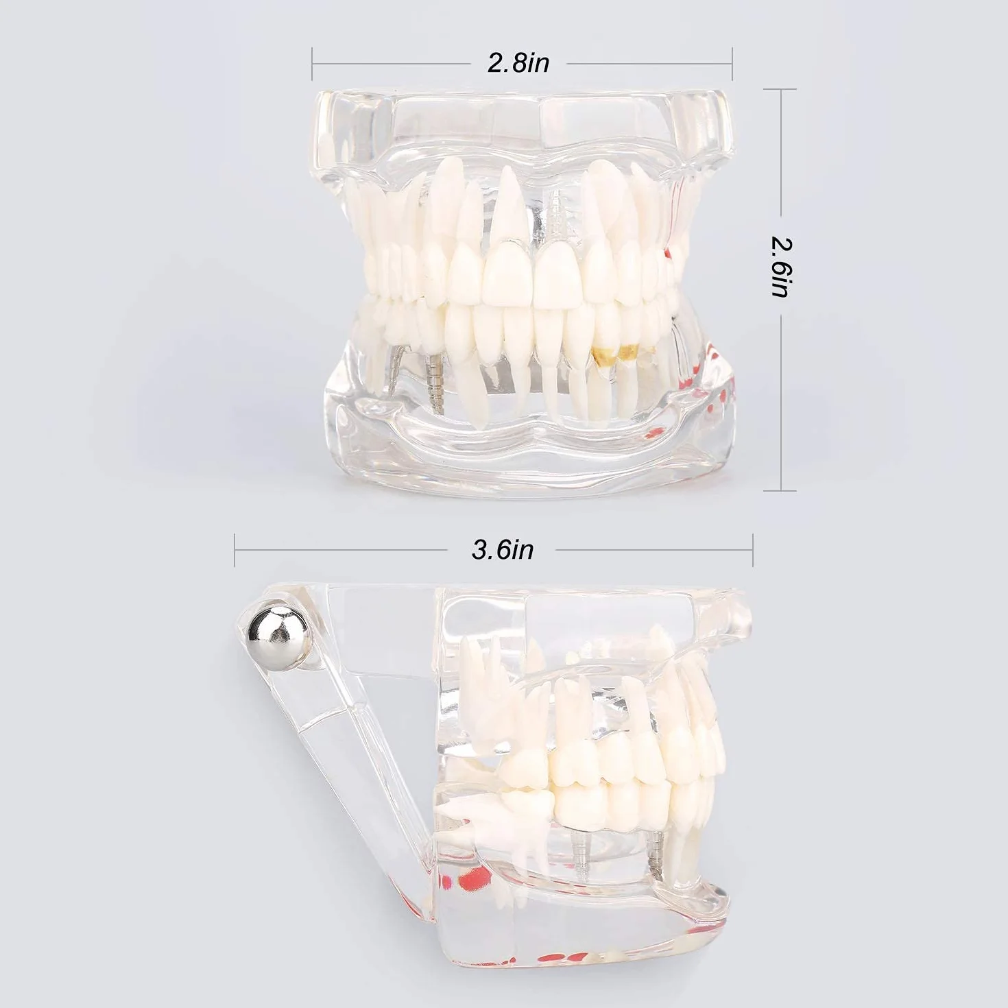 Modelo de Dientes Desmontable Adultos, Implantes Dentales, Enfermedad Transparente, Patología de Enseñanza