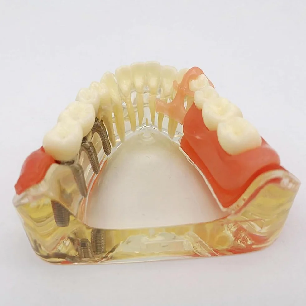 Implant-Supported Restorations Comparison Model Transparent Dental Implant Model Education Study