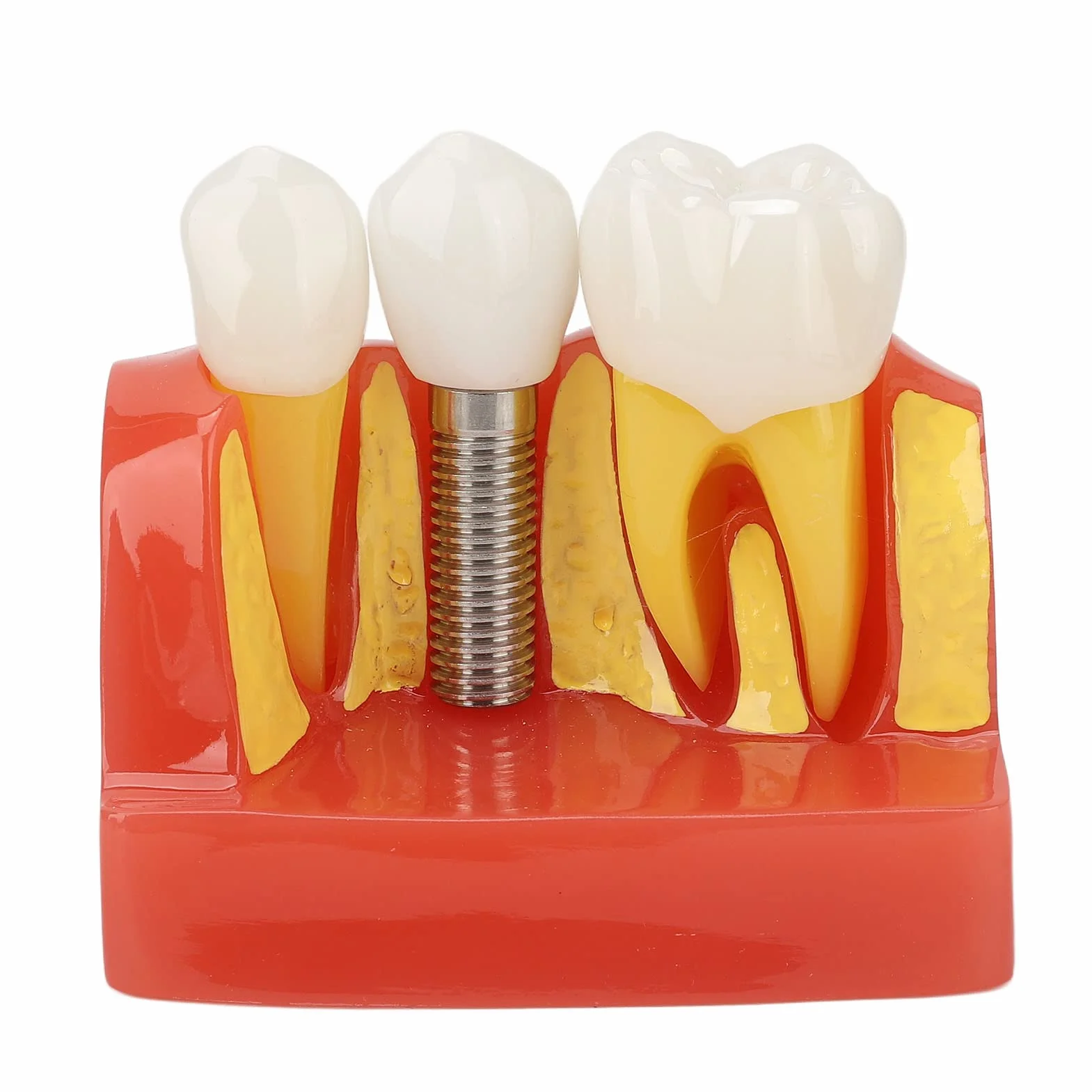 Modelo de implante Dental con Corona y Puente extraíbles para demostración y formación